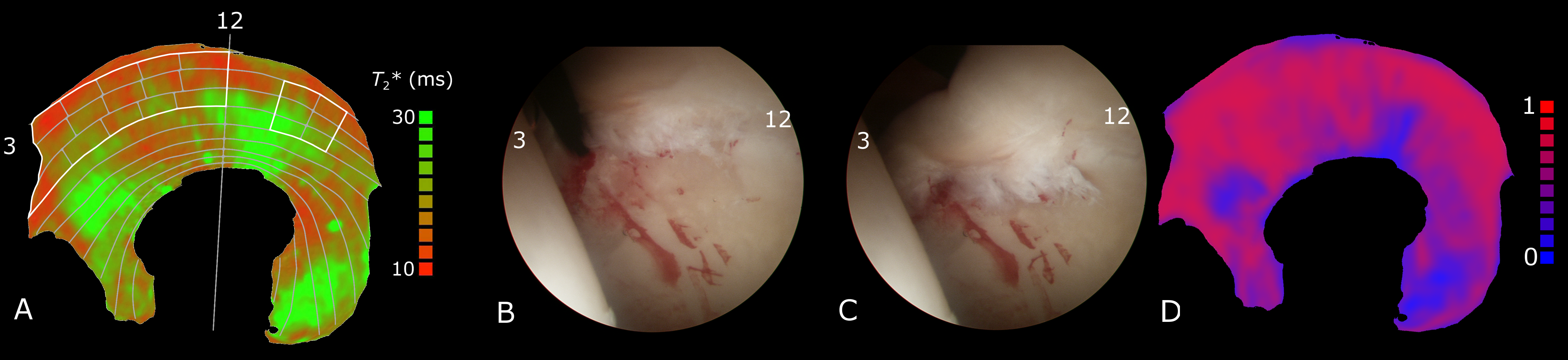 msk-cartilage-t2.png